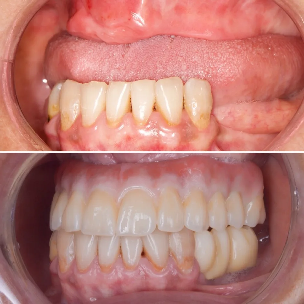 Rehabilitación completa sobre implantes — antes y después