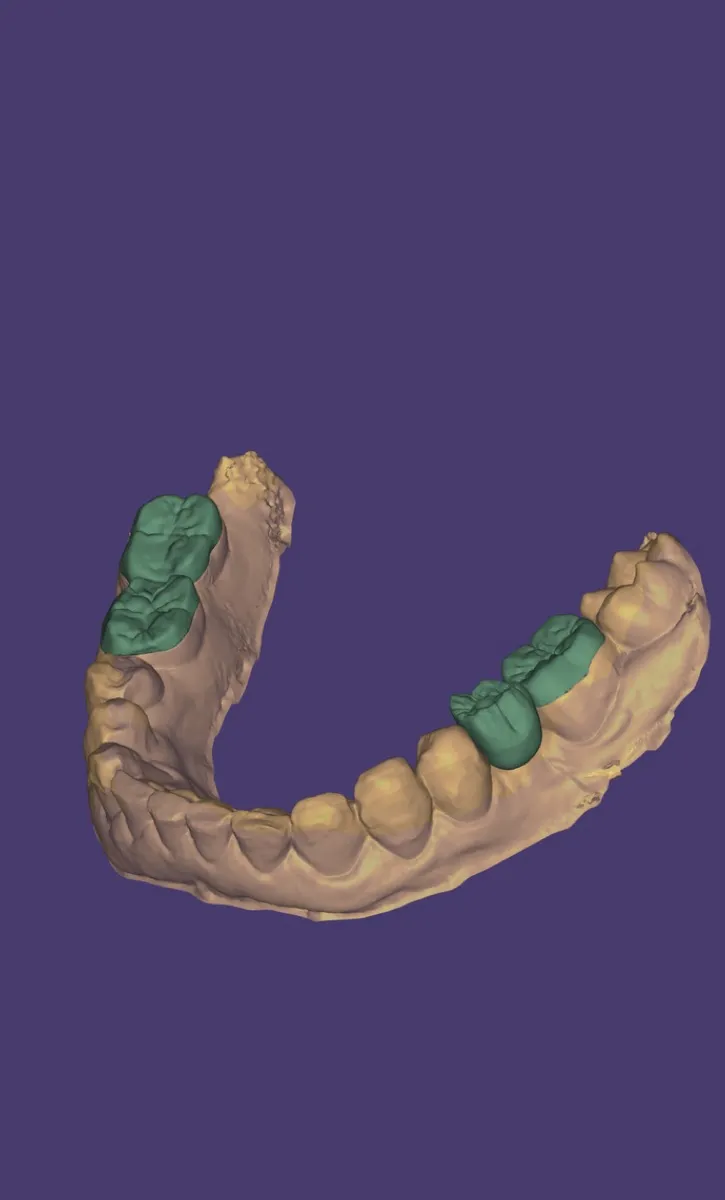 Escaneo digital 3D para planificación de implantes