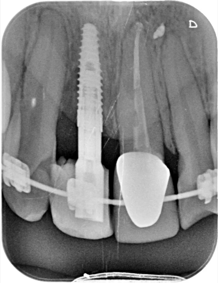 Radiografía que permite observar la posición y evolución estructural de los implantes